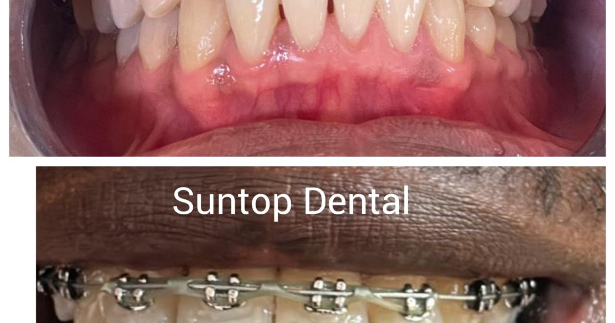 professional dental braces treatment