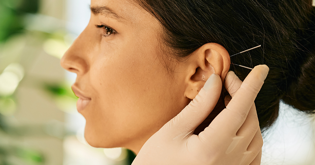 Auricular Acupuncture- 30 minutes